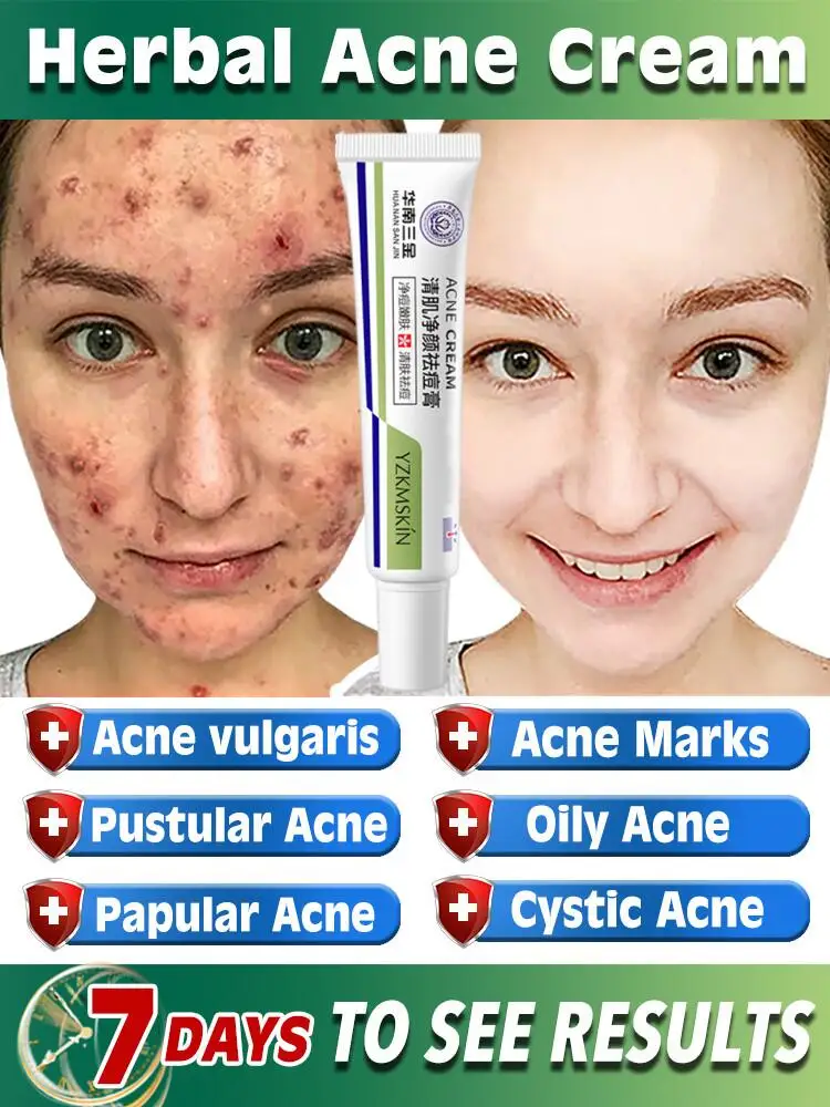 

Крем от акне, травяные экстракты от акне, эффективное противовоспалительное масло, контроль прыщей, восстановление кожи, увлажнение, уход за кожей