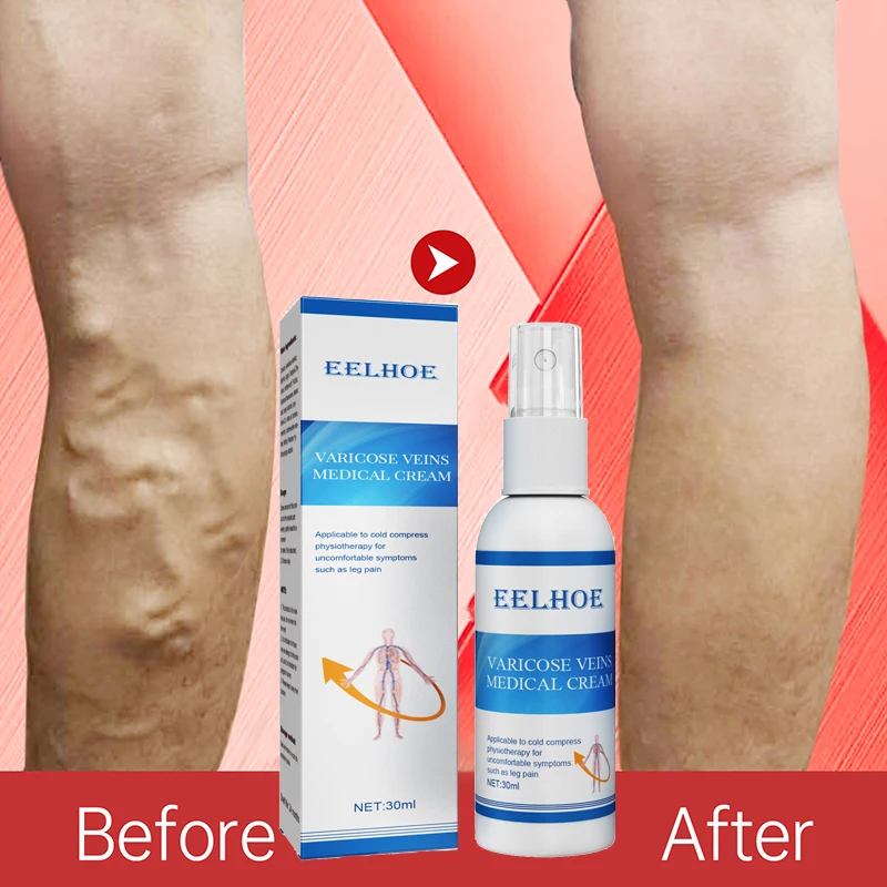 

30g Varicose Vein Soothing Spray Veins Treatment Spray On Leg Acid Bilges Itching Earthworm Lumps Bad Leg Cure Natural Solution