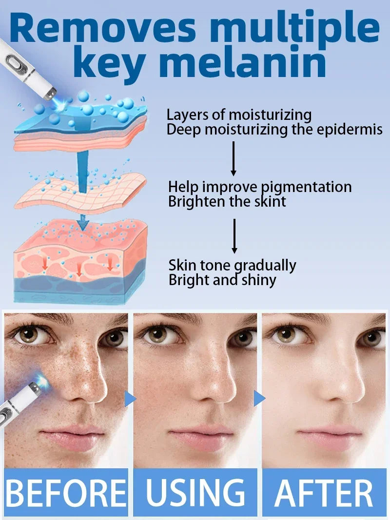 Лазер от солнца темные пятна веснушки уменьшение хлоазмы