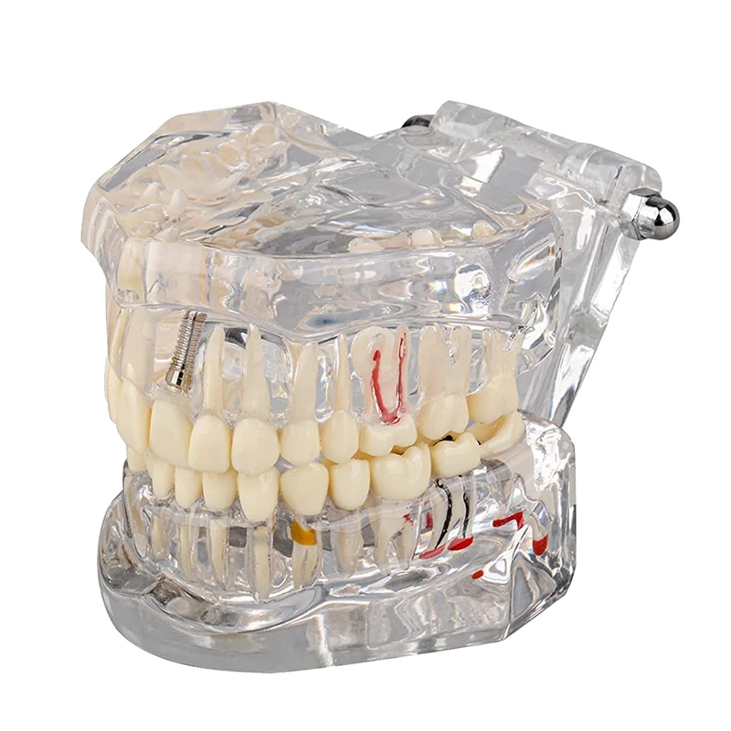 

1 Piece Transparent Disease Teeth Model With Implant Bridge, Transparent Plastic For Patient And Student Education