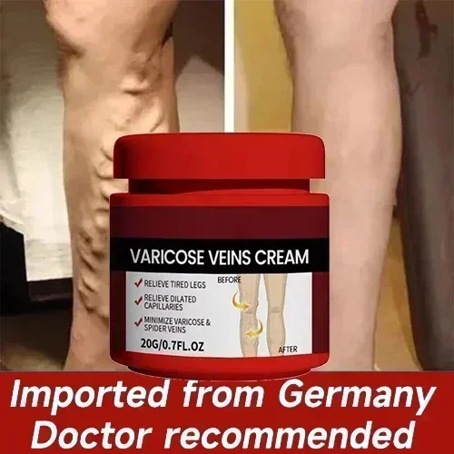 Инт для варикозного расширения вен васкулит флебит паук удаление ангиита из трав