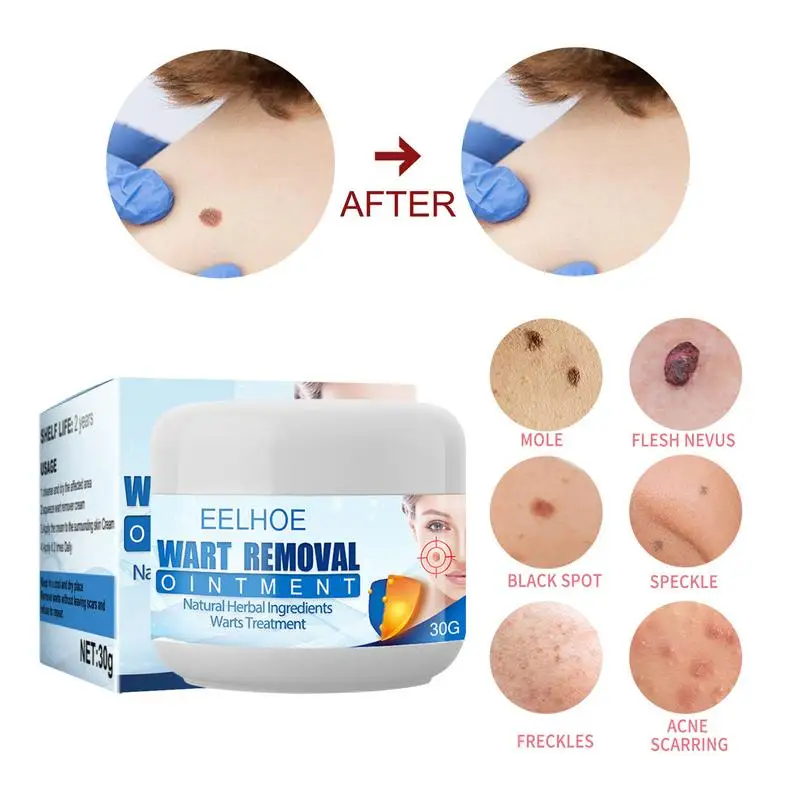 

Крем-Антибактериальный для удаления бородавок, бородавок, родинок, 30 г