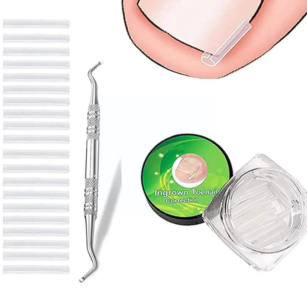 

10/20pcs Ingrown Toenail Correction Tool Treatment Pedicure Patch Straightening Feet Brace Elastic Clip Sticker Care Pedicu P0C1