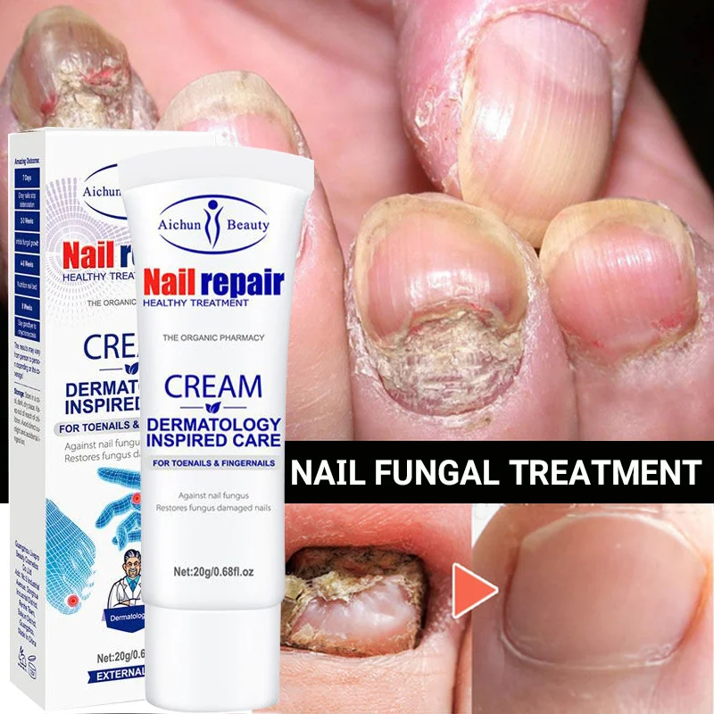 

Nail Fungus Treatment Cream Hand Feet Nail Care Remove Onychomycosis Paronychia Anti Infection Nourish Repair Herbal Ointment