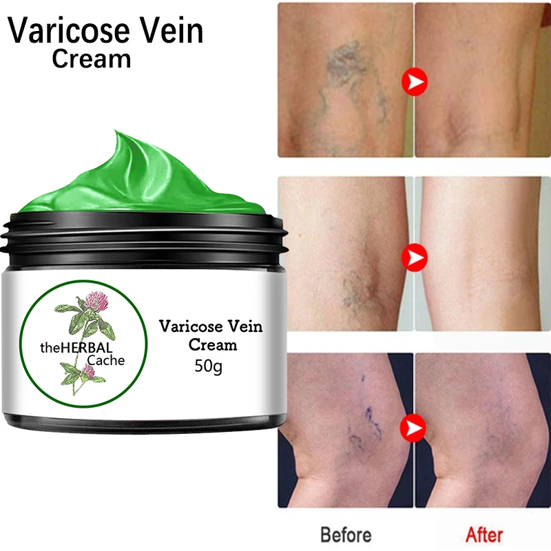 

Effective Varicose Veins Relief Cream Relieve Vasculitis Phlebitis Spider Pain Treatment Ointment Medical Plaster Body Care