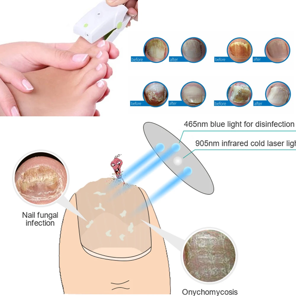 905NM painless nail fungus therapeutic instrument Laser foot care whitening nail removing fungus infection nail therapeutic inst