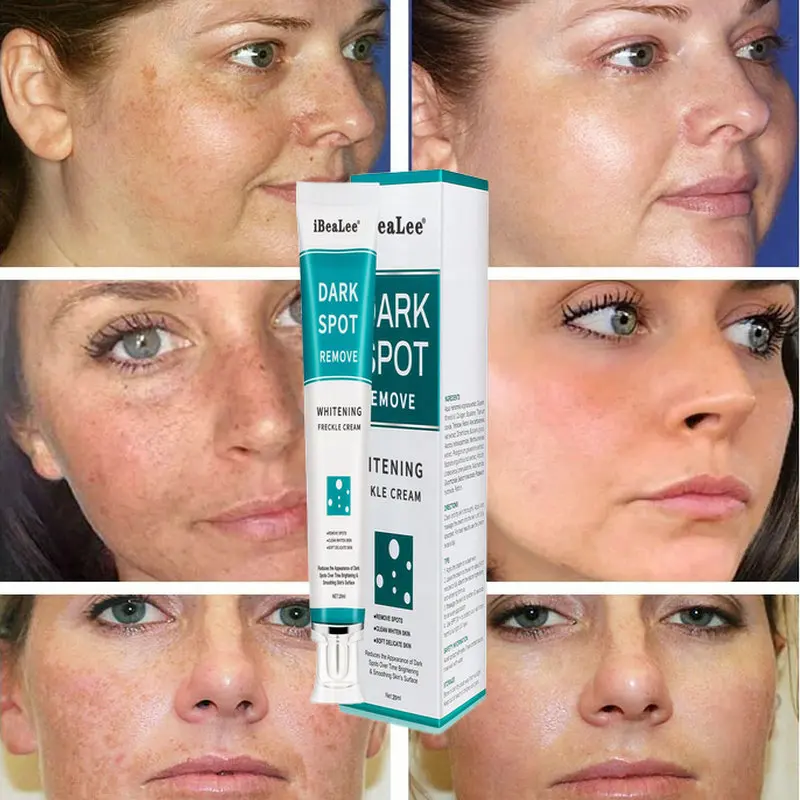 Whitening And Freckle-removing Cream To Lighten Pigmentation And Mild Freckles, Age Spots And Chloasma Repair Cream
