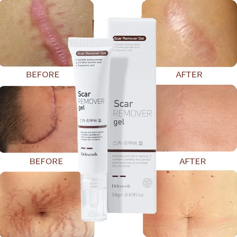 

Крем для удаления рубцов и акне, восстанавливающий растяжки для беременных, гель для удаления ожогов и шрамов, хирургическое лечение, гладк...