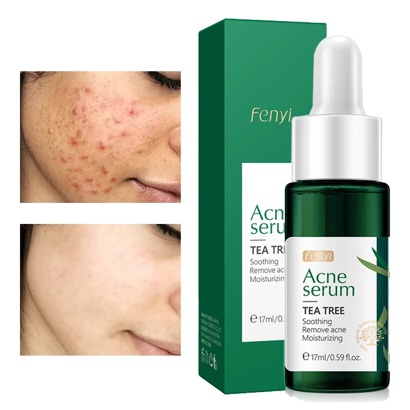 

Acne Serum Nourishing Repair Moisturizing Acne Treatment Reducing Acne Marks Soothing Shrinking Pores Oil Control Skin Care