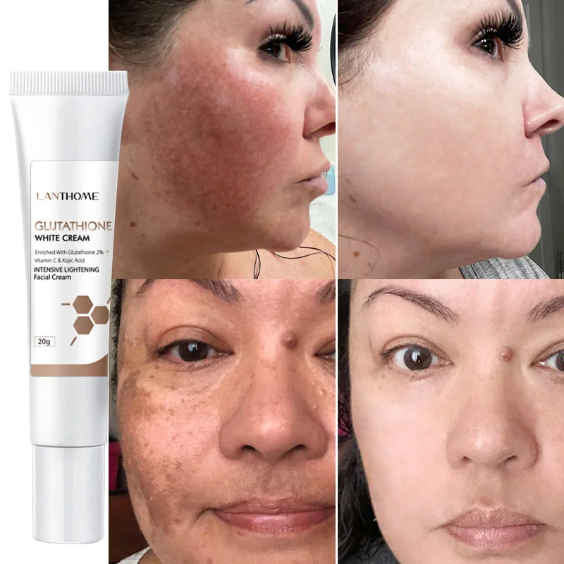 Whitening Freckle Cream Remove Acne Spots Melanin Dark Spots Face Cream Improve Dullness Fast Brighten Nourish Skin Care