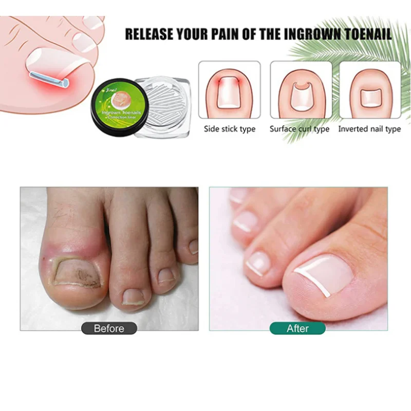 Рисунок 5 - Инструмент для коррекции вросших ногтей