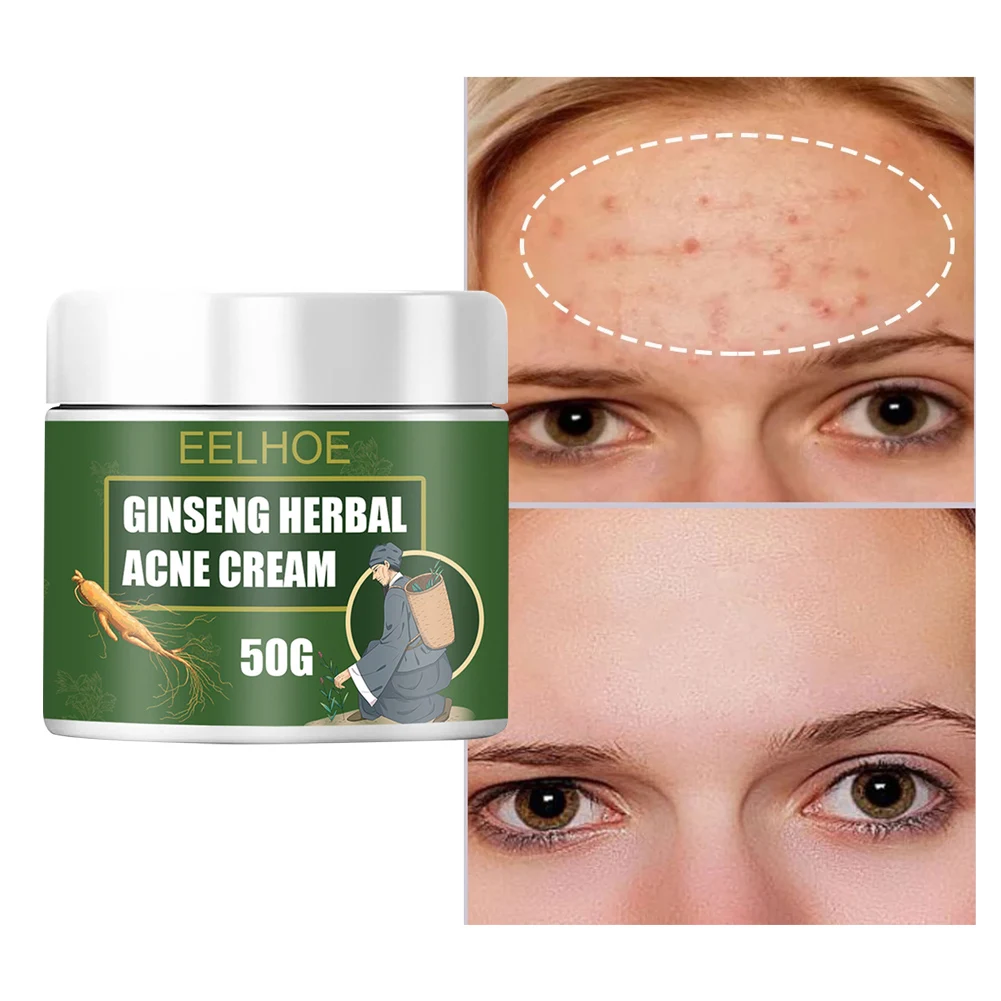 

Acne Removal Cream Natural Herbal Acne Treatment Skin Repairing Ointment Lighten Acne Marks Pimples Oil Control 10/20/30/50g
