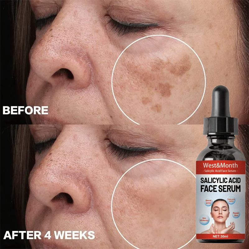 Whitening Freckle Cream Anti-Aging Improve Dullness Remove Dark Spots Melanin Melasma Brighten Face Skin Care Beauty Essentials