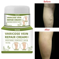 varicose vein treatment cream leg raised thigh spider vasculitis phlebitis repair ointment swelling pain relief medical plaster