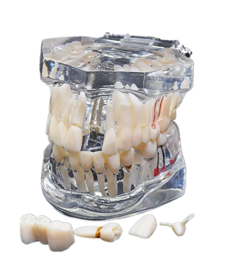 Мост для восстановления зубных имплантатов стоматологическое обучение