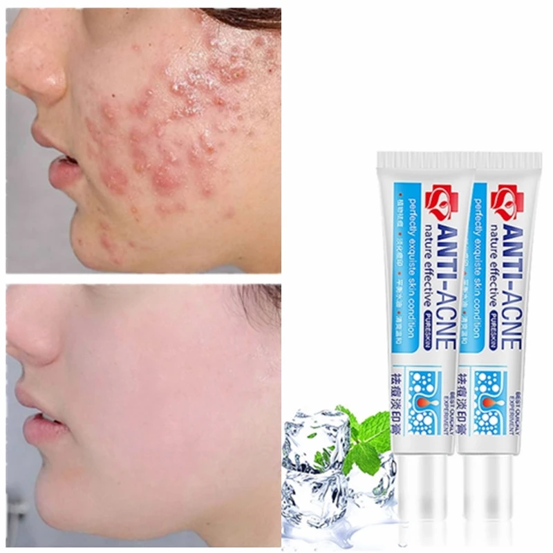 

30g Herbal Acne Cream To Lighten Acne Marks and Mild Acne Removal Blackheads, Anti-acne Treatment, Repair Cream, Acne Cream