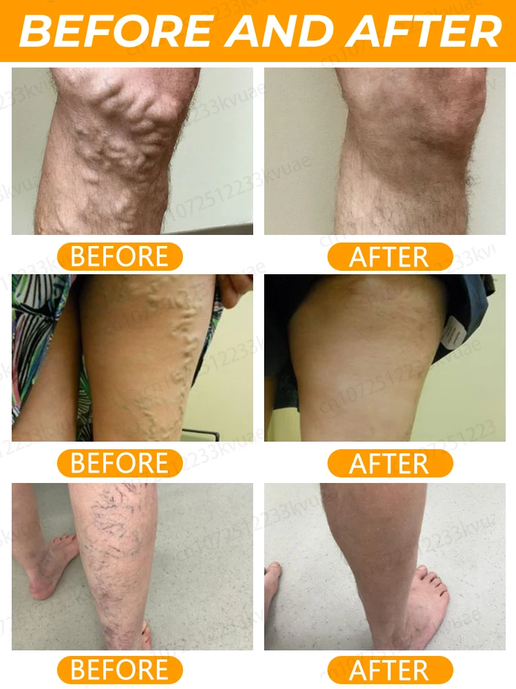 Мазь от варикозного расширения вен 7-дневное лечение опухших кровеносных сосудов