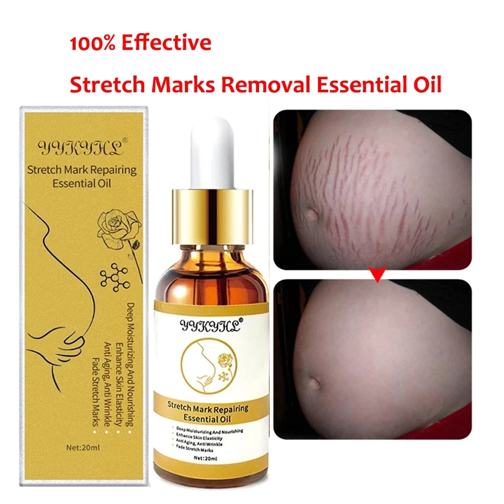 Stretch Marks Remover Essential Oil Skin Care Treatment Cream For Stretch Mark Removal Maternity Slackline For Pregnant Oils