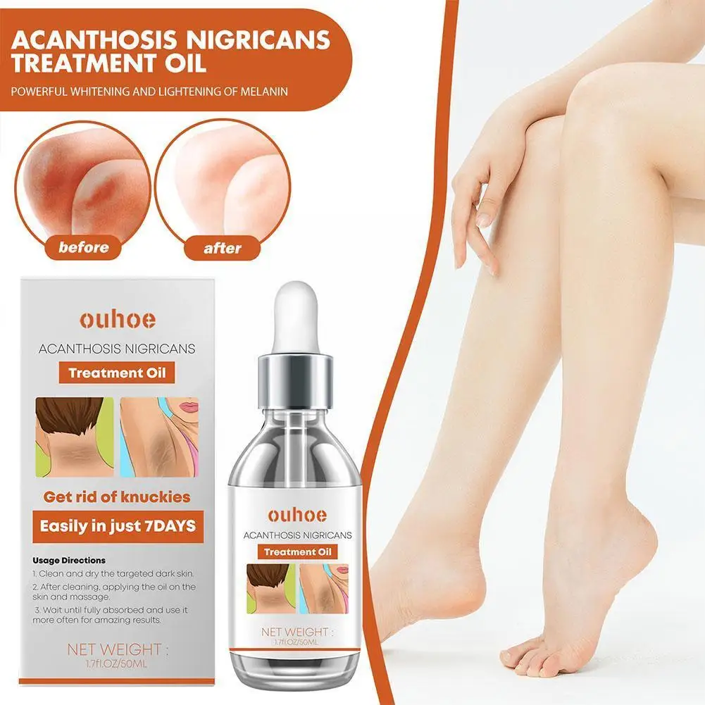 

50 мл Acanthosis Nigricans лечебное масло для лечения нигриканов и пятен, вызывающие акантоз Патчи от Dark Y2X1 B7Y2