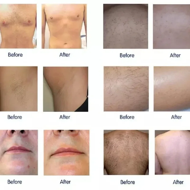 Профессиональная машина для удаления волос OPT IPL использования в салоне с 500000