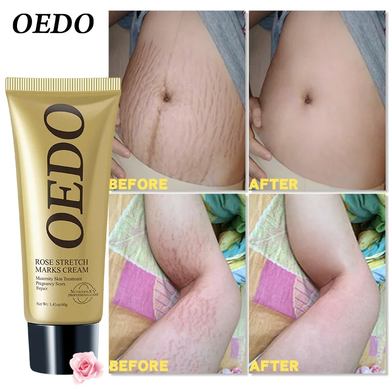 

Rose Remove Stretch Marks Cream Anti Wrinkle Anti Aging Maternity Skin Repair Remove Pregnancy Scars Treatment Body Skin Care