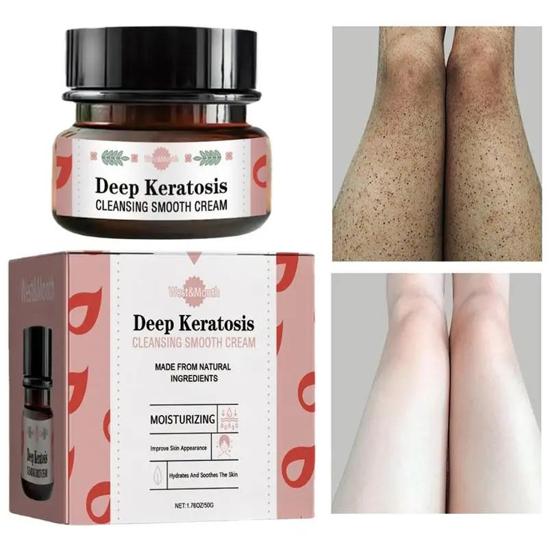 

Keratosis Pilaris Repair Cream 50g Moisturizing Improves Dry Rough Bulging Skin Removal Chicken Skin Deep Smooth Skin Care