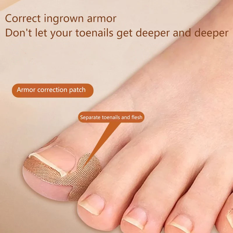 100 шт. пластырь для ногтей с грибком восстановления вросших Наклейка коррекции
