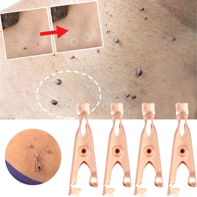

1/2pcs Wart Remover Small Clip Copper Skin Tag Remover Micro Strip Cleaning Skin Tag Removal Kit Facial Beauty Makeup Tools