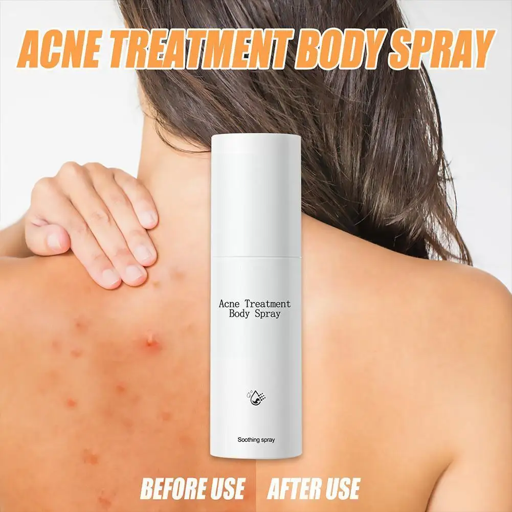 100ml New Acne Treatment Spray Moisturizing Spray Skin Essence Face Spray Acne Oil Treatment Oil-control Q6g8