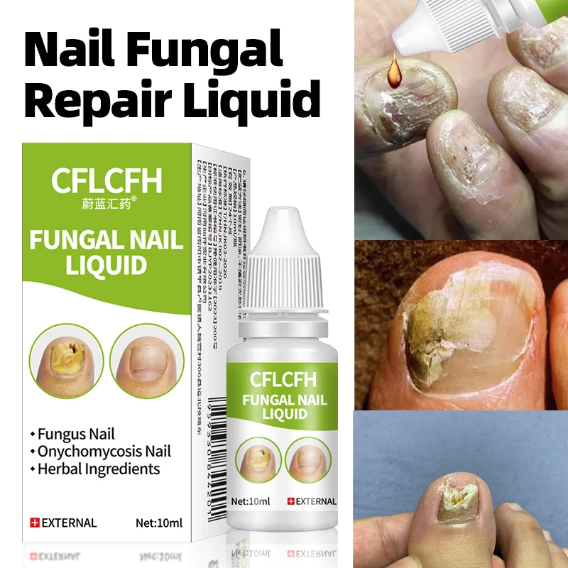 Средство для лечения Ногтей от грибков жидкость удаления онихомикоза у пальцев