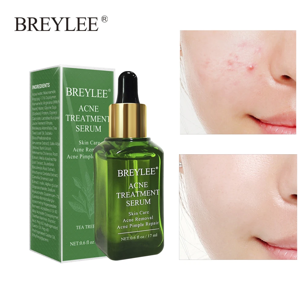 

BREYLEE Acne Treatment Face Serum Mask Anti Acne Pimple Scar Remover Moisturizing Whitening Skin Care Facial Essence Cream 17ml