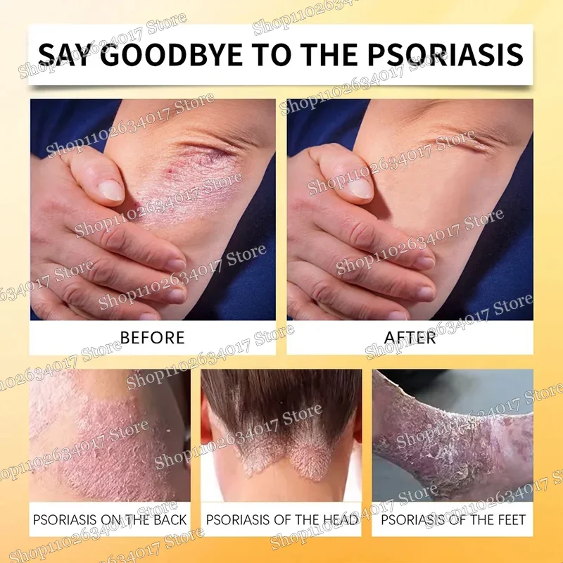 Псориаз Антибактериальный против зуда Дерматити Экзема Крапивница Алергия Кожа
