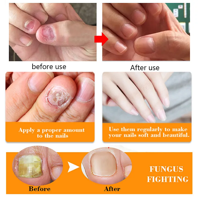 Антигрибковая Сыворотка для ногтей лечение онихомикоза восстановление