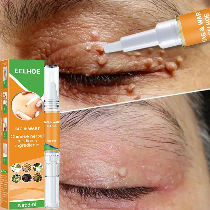 

Painless Skin Tag Removal Essential Oil Body Wart Elimination Essence Natural Plant Extracts Treatment Black Mole Skin Care Kit
