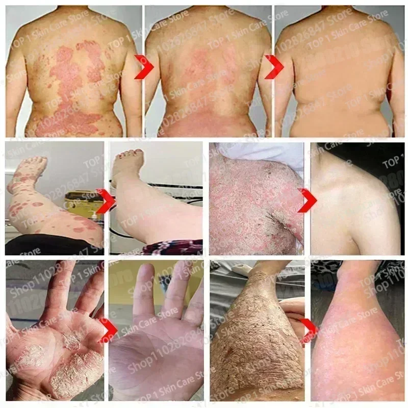 Увлажняющий крем от псориаза естественный ремонт эффективно антибактериальный