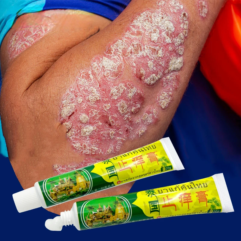 10 pcs Psoriasis Removal Cream Treat Psoriasis Eczema Dermatitis Ointment Skin Allergies Cool Relief Itch Inhibit Health Care