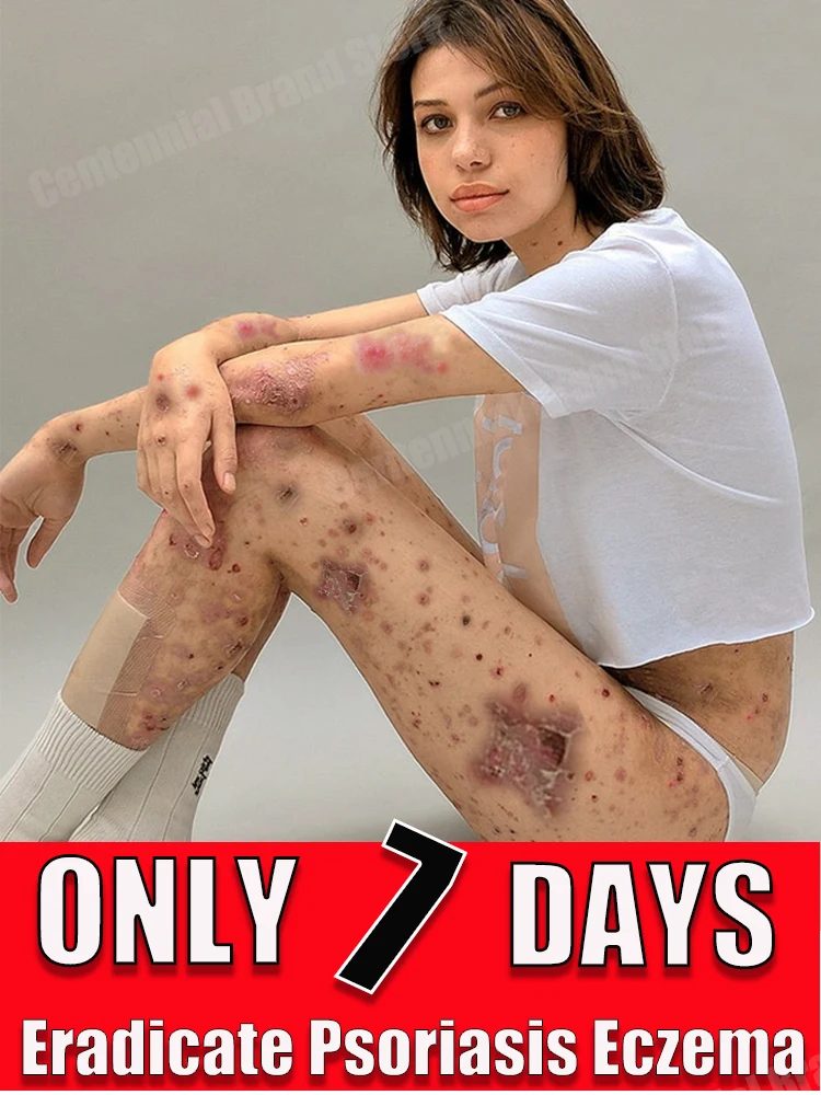 Антибактериальный крем против зуда для лечения псориаза