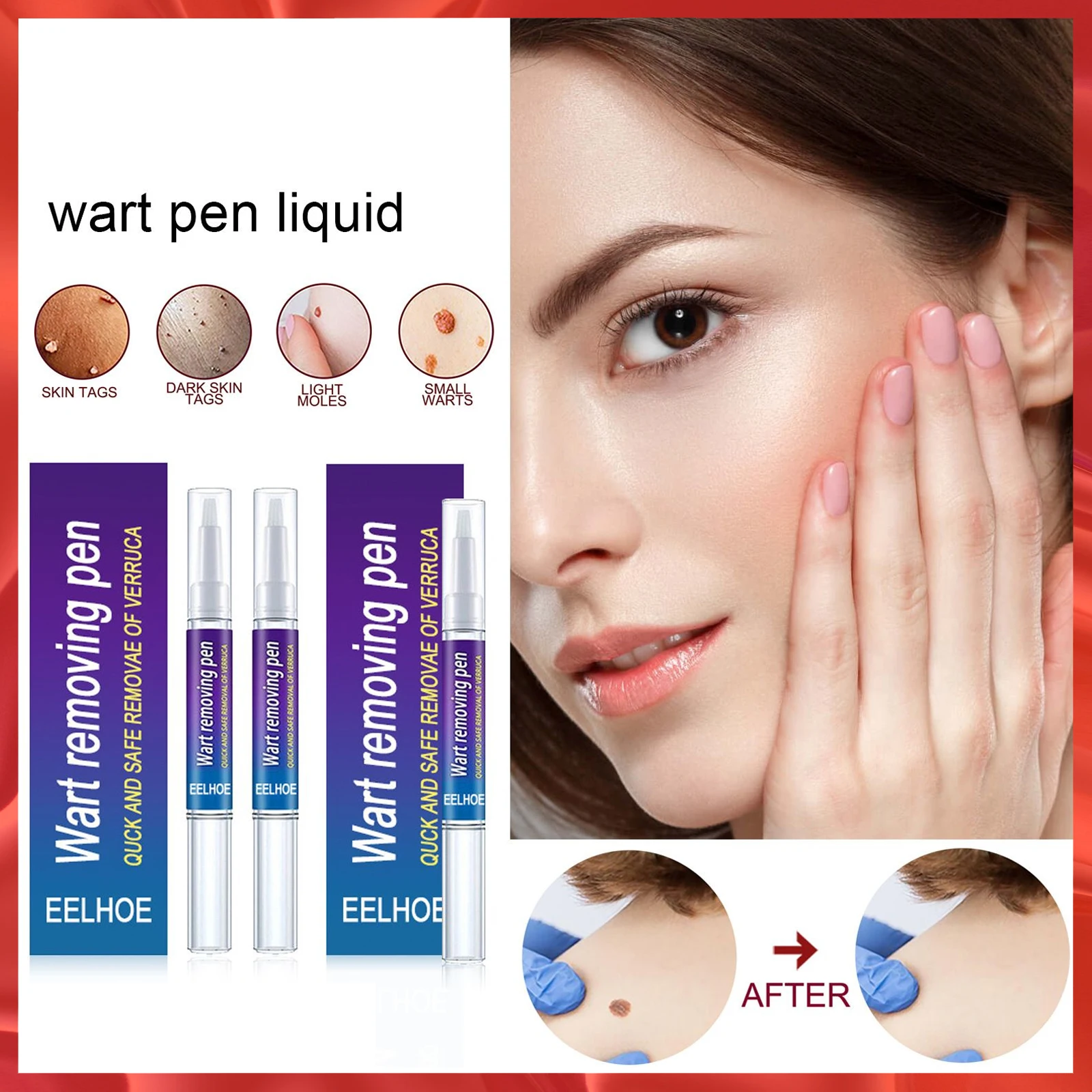 

Wart Pen Removal Against Moles Flat Warts Acuminate Anti Verruca Removal of Warts Liquid From Skin Tags Treatment Papillomas 10g