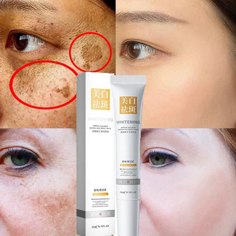 

Effective Freckle Whitening Cream Whiten Dark Spots Speckles Fade Melanin Pigmentation Melasma Brighten Pregnancy Sun Spot 20ml