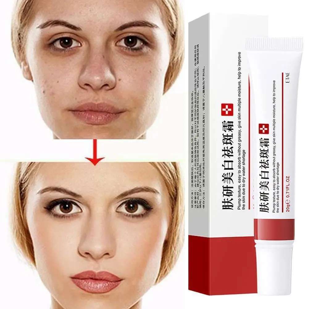 

Powerful Whitening Freckle Cream Remove Melasma Acne Pigment Moisturizing Pigmentation Melanin Gel Care Dark Spot Skin Spot B8p1