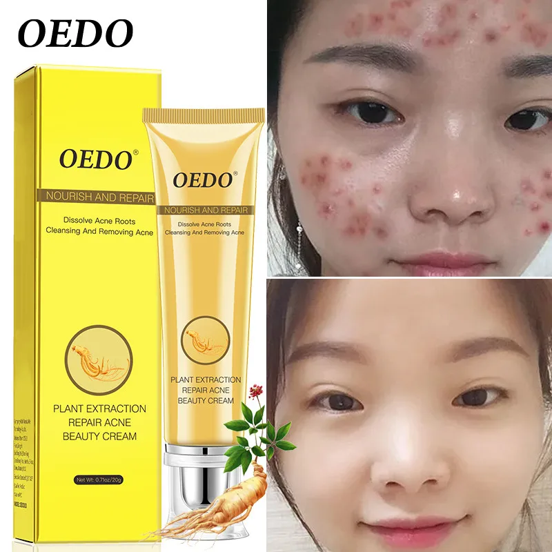 

Effective Acne Removal Spots Oil Control Skin Care Whitening Moisturizing Gel Skin Products Face Cream Cosmetics