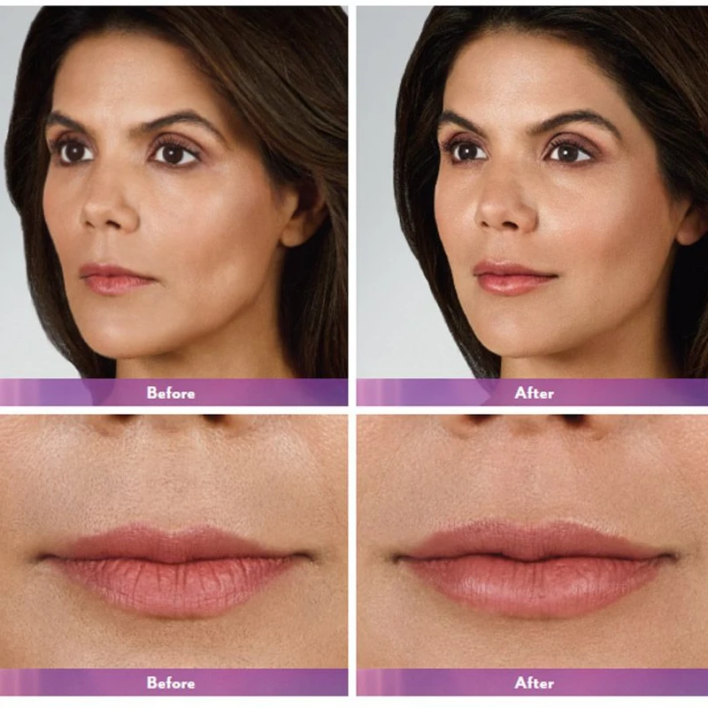 

2pcs 1ml French Juve Hyaluronic Acid Serum HA Moisturizing Repair Facial Wrinkles Anti-aging Lip Fine Line Skin Care