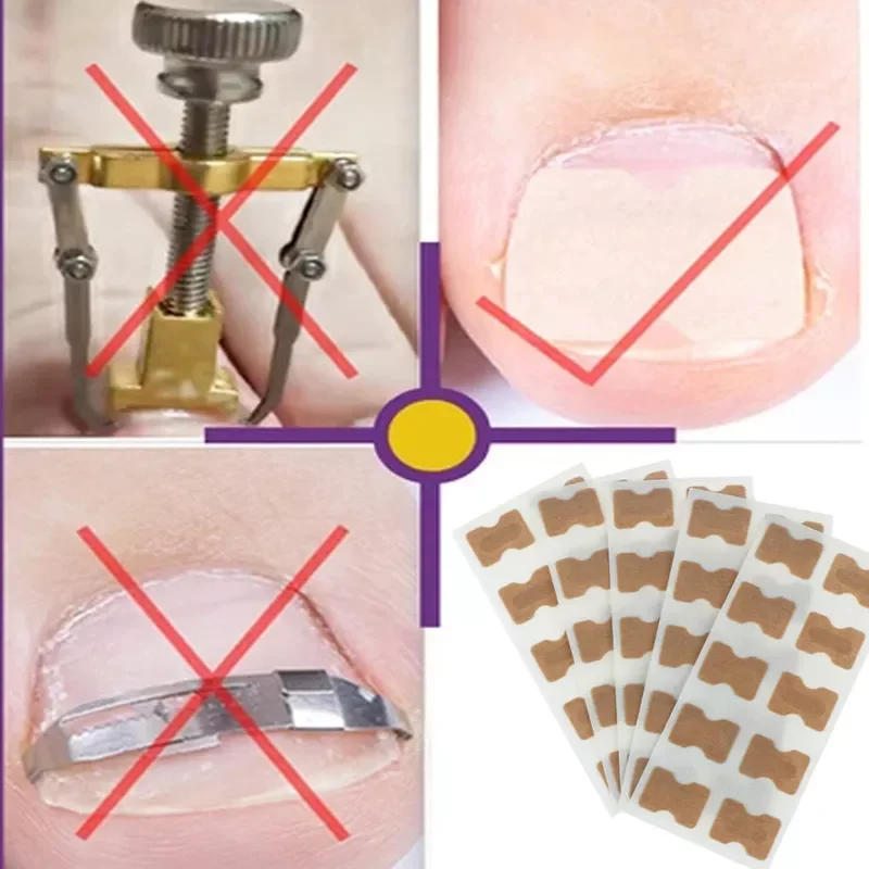 

NEW2023 5 pieces of 50 stickers ingrown toenails treatment for toenails repair nail correction stickers foot care