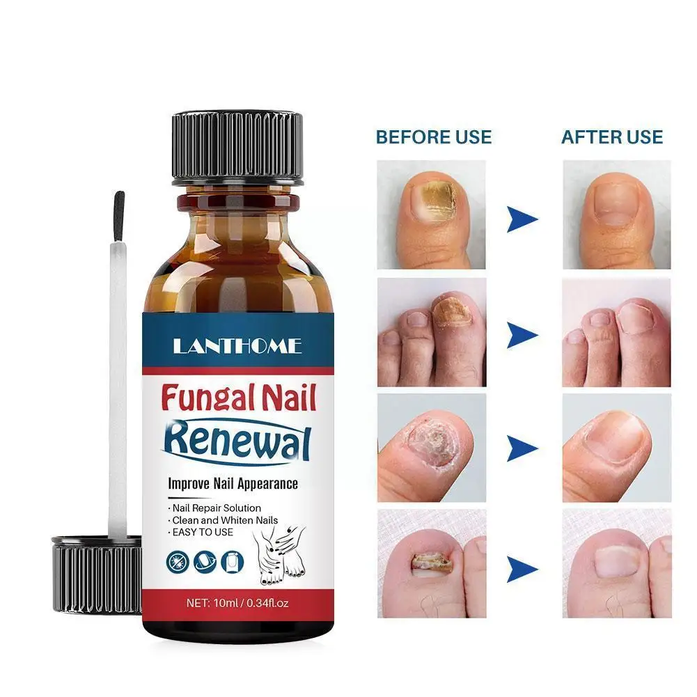 

Lanthome 10ml Nail Repair Essence Serum Fungal Nail Skin Toe Brighten Hand Nourishing Remove Care Onychomycosis Treatment F C4t2