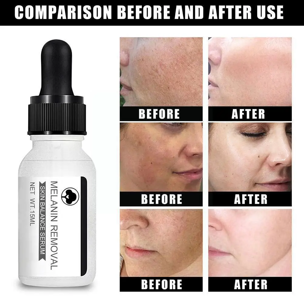 

Whitening Freckle Essence Whitening Lightening Blemish Pigmentation Fade Dark Melasma Spots Remove Essence Freckle Anti Liq U9l7