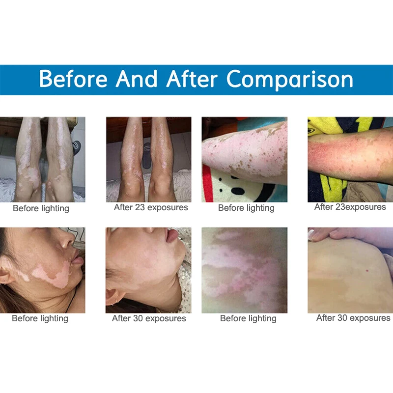 Uvb лампа оборудование для физиотерапии узкополосные лампы фототерапии