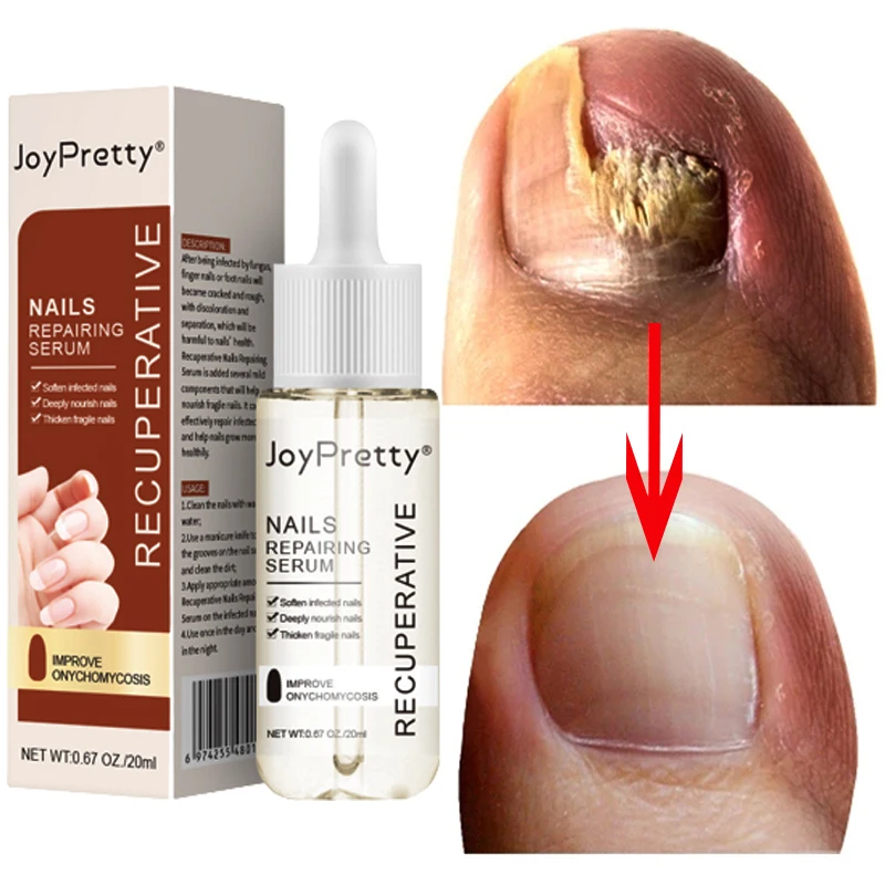 средство от грибка ногтей эффективное. средство от грибка ногтей эффективное. чем лечить грибок ногтей на ногах отзывы. антифунгол emi. советское средство от грибка ногтей.