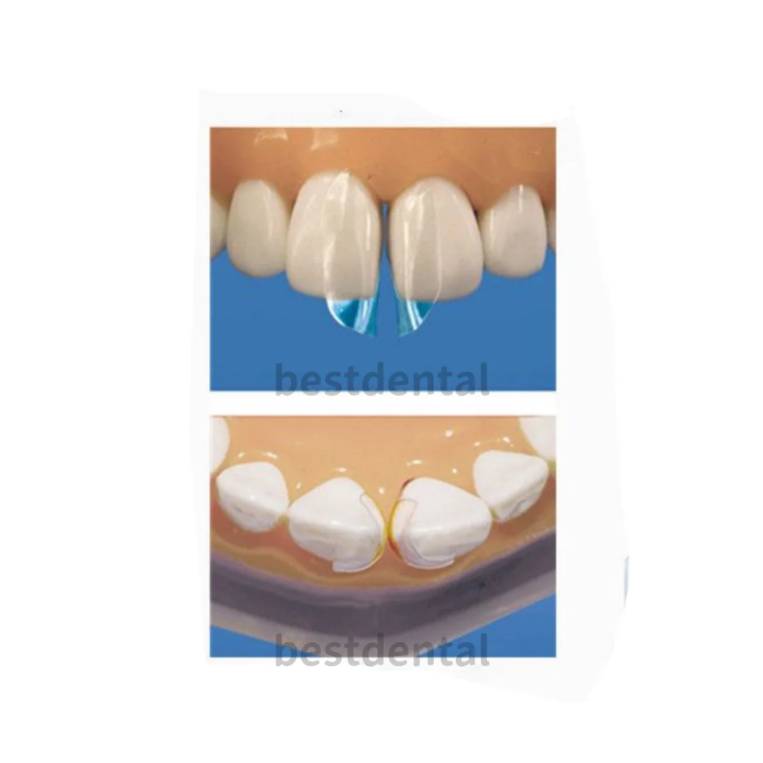 Стоматологические матрицы разных размеров диастема подходит для биопрозрачного