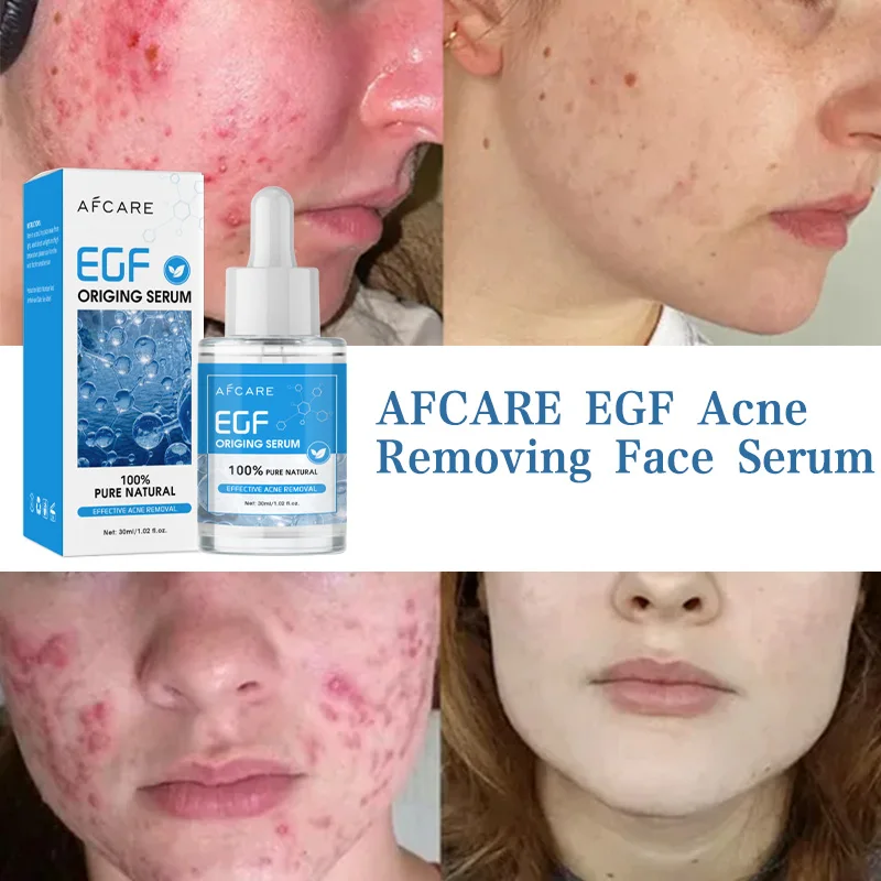 Олигопептидная сыворотка для лица против прыщей EGF лечение эссенция уменьшение