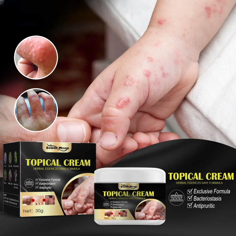 

Sdotter Professional Hand foot antipruritic ointment skin dry Treatment mosquito bite Anti itch topical cream Herbal Plaster Ski
